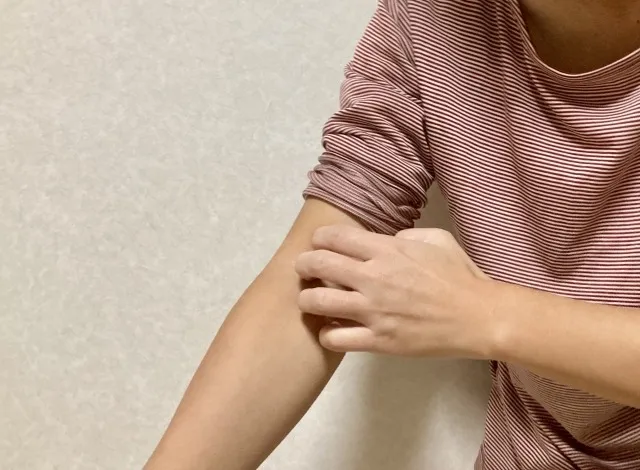 トコジラミによる健康被害